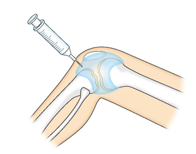 関節内注射