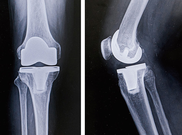人工膝関節全置換術後のレントゲン（正面と側面）