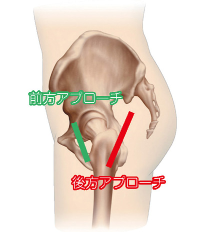 前方アプローチと後方アプローチ