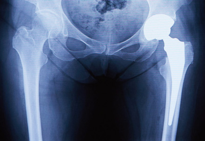 人工股関節置換術後のレントゲン