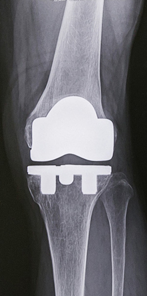 人工膝関節全置換術後のレントゲン