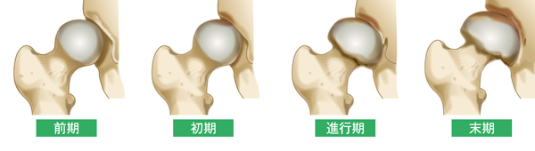 変形性股関節症の進行