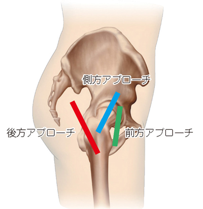 後方／側方／前方アプローチ