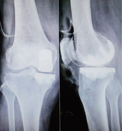 人工膝関節部分置換術後のレントゲン（正面と側面）