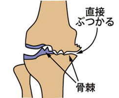 変形性膝関節症