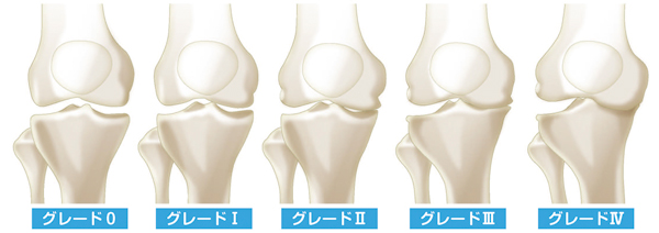 変形性膝関節症のKL分類