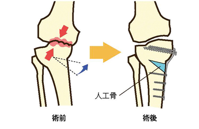 オープンウエッジ法