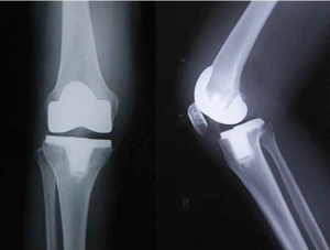 人工膝関節全置換術後のレントゲン（正面と側面）