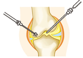 関節鏡手術と骨切り術