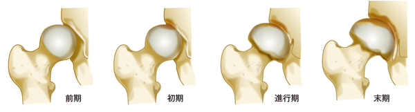 変形性股関節症