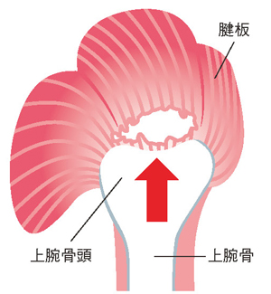 腱板断裂