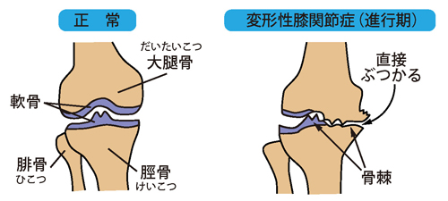 正常な膝と変形性膝関節症