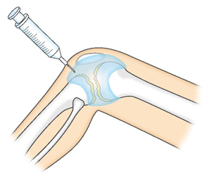 関節内へのヒアルロン酸注射