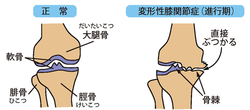 正常な膝と変形性膝関節症