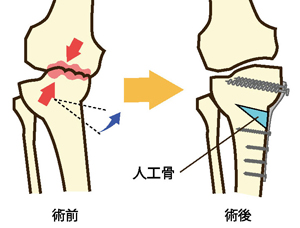 高位脛骨骨切り術