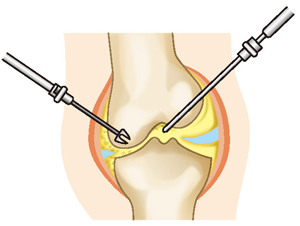 関節鏡視下手術