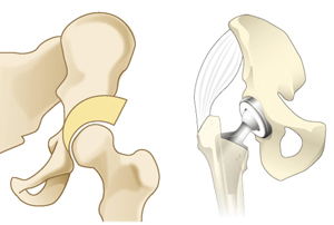 骨切り術と人工股関節置換術
