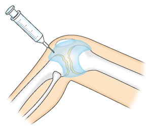 ヒアルロン酸の関節内注射