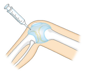 ヒアルロン酸の関節注射