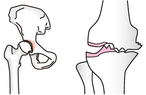 変形性膝関節症／変形性股関節症