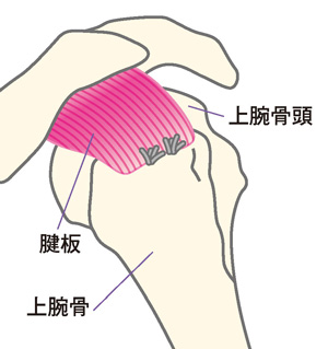 切れた腱板と骨を縫合