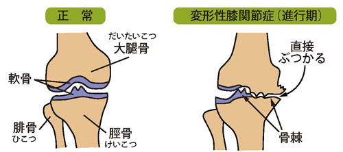 変形性膝関節症