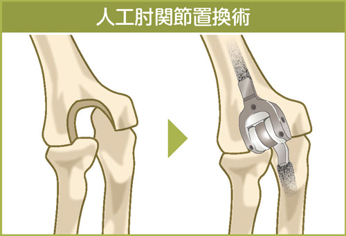 人工肘関節置換術