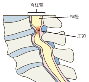 腰部脊柱管狭窄症