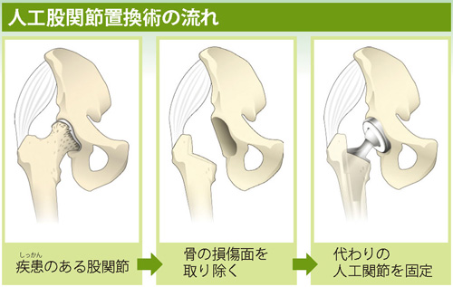 人工股関節置換術の流れ