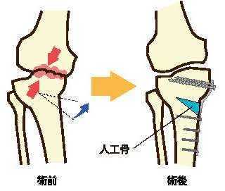 高位脛骨骨切り術