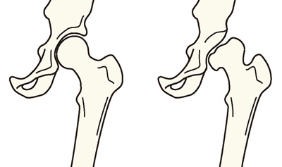 正常な股関節／寛骨臼形成不全