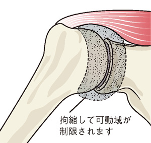 今井 晋二 先生 肩が痛い 腕が上がらない 主な原因は何ですか 第304回 肩が痛い 腕が上がらない 肩の痛みの原因はさまざま 放置せず早めに受診し適切な治療を受けましょう 人工関節ドットコム