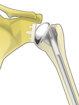 従来の人工肩関節