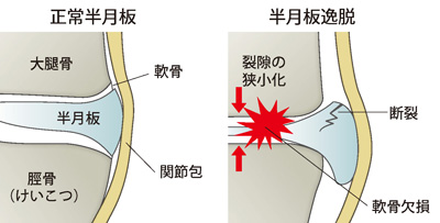 正常半月板と半月板逸脱