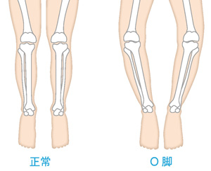 正常な膝とO脚