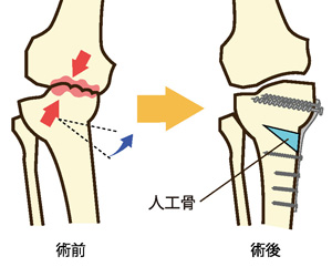 骨切り術