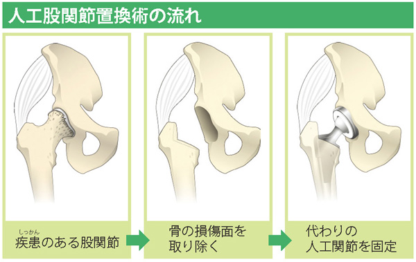 人工股関節置換術の流れ