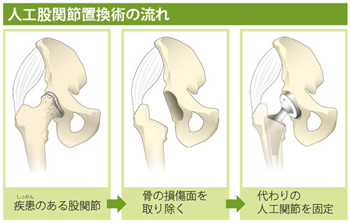 人工股関節置換術の流れ