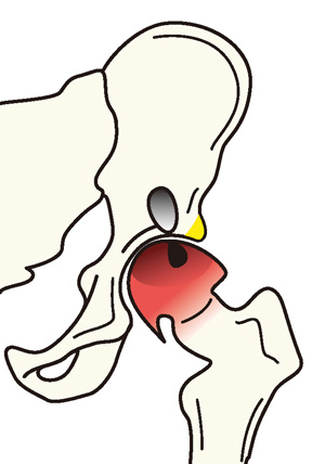 大腿骨頭壊死