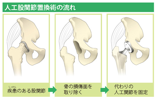 人工股関節置換術の流れ