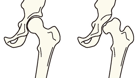 正常な股関節と寛骨臼形成不全