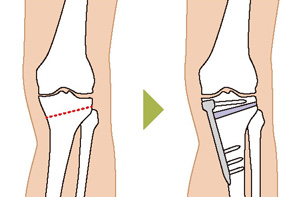 高位脛骨骨切り術