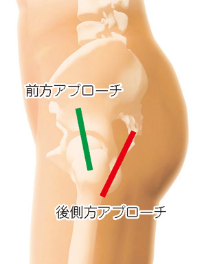 前方アプローチと後側方アプローチ