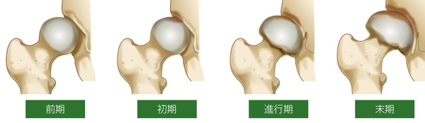 変形性股関節症の4段階