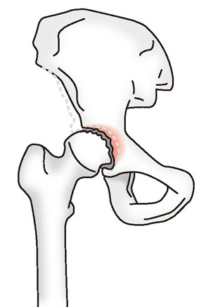 変形性股関節症