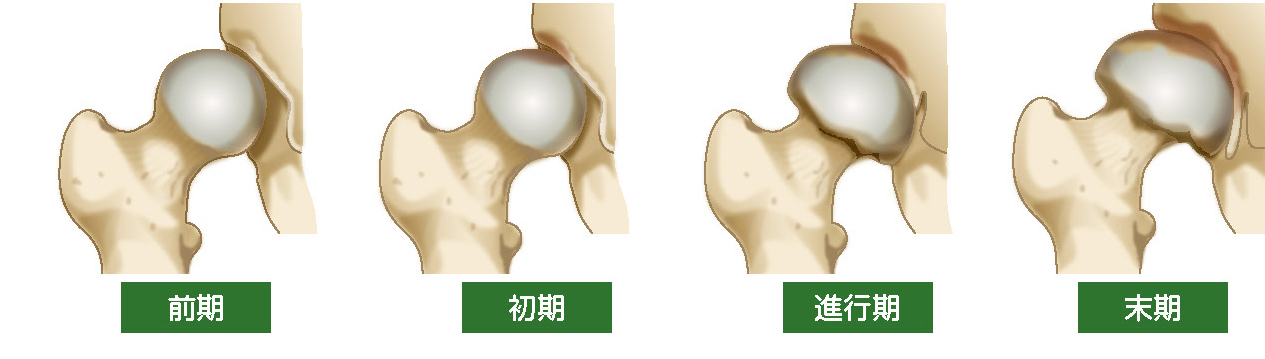 変形性股関節症の進行