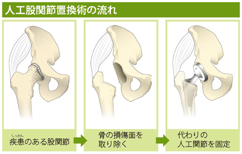 人工股関節置換術の流れ