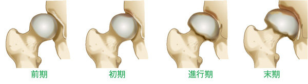 変形性股関節症の進行