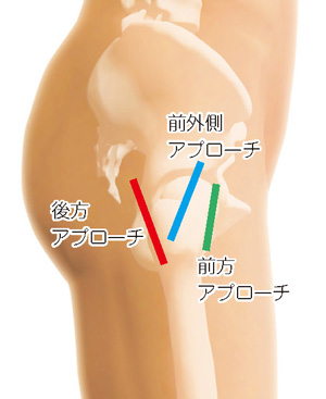 前方アプローチ、前外側アプローチ、後方アプローチ