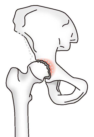変形性股関節症